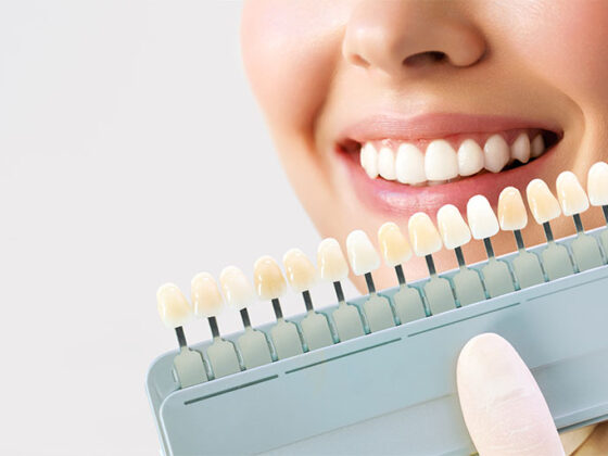 Clinica dental maestro. Comparación de blancos en blanqueamiento dental