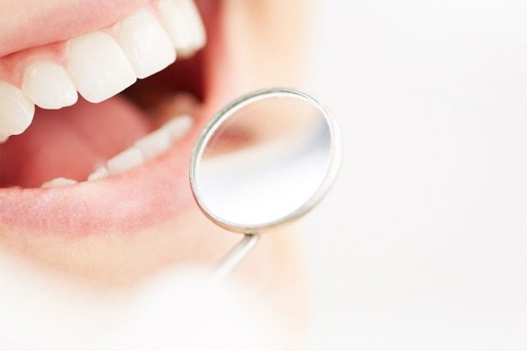 Carillas dentales: precio, materiales, consejos y alternativas