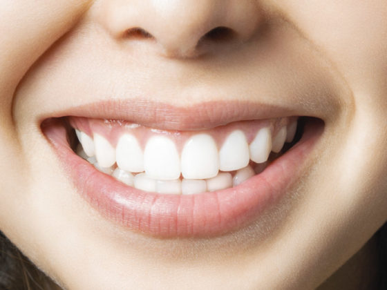 Carillas dentales: ¿Cuáles son sus principales ventajas?