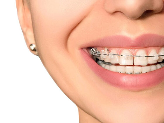 Consecuencias del diastema dental ▷ Clínica Dental Maestro