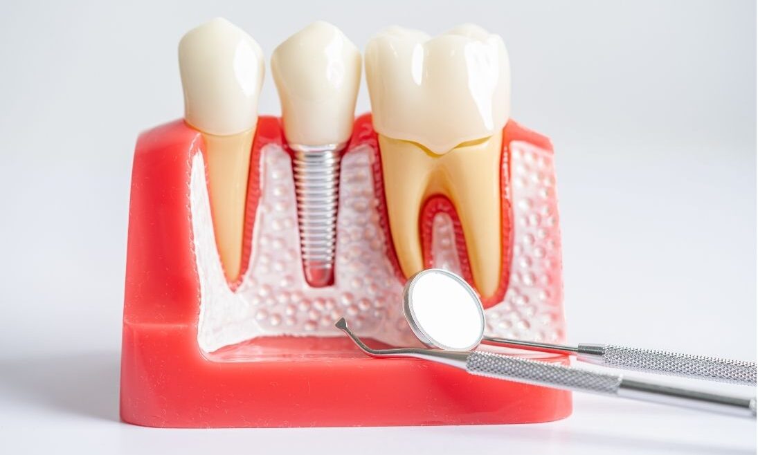 como saber si necesito implantes dentales clinica dental maestro oviedo