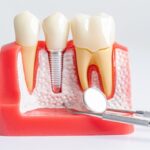 como saber si necesito implantes dentales clinica dental maestro oviedo