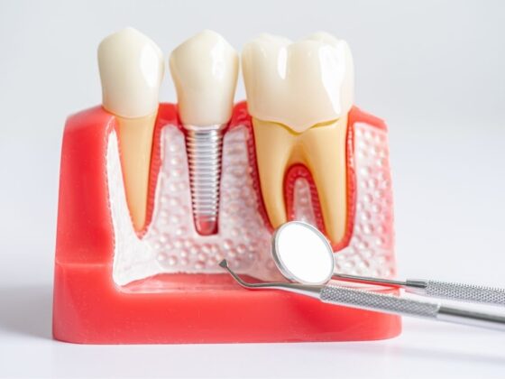 como saber si necesito implantes dentales clinica dental maestro oviedo