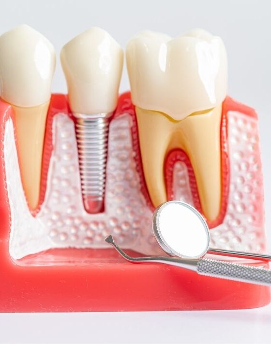 como saber si necesito implantes dentales clinica dental maestro oviedo