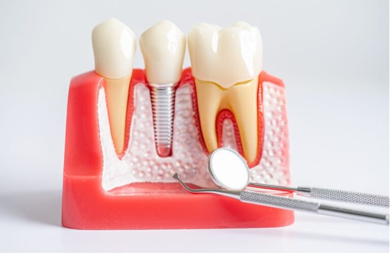 como saber si necesito implantes dentales clinica dental maestro oviedo